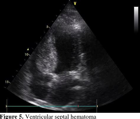 Figure 5 from Septal hematoma due to stent implementation in the septal course of the left ...