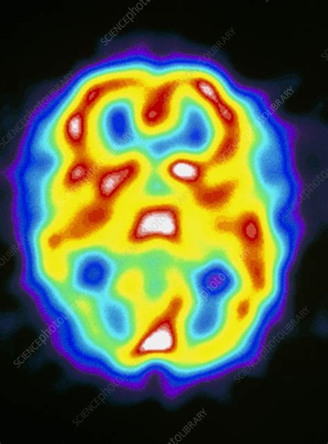 Brain during migraine, SPECT scan - Stock Image - M210/0103 - Science Photo Library