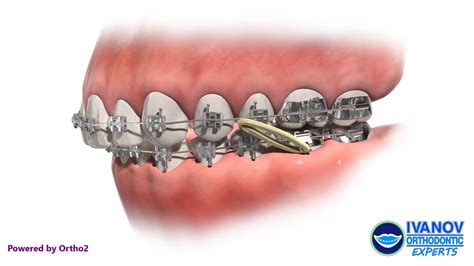 Do Braces Help Correct An Overbite?