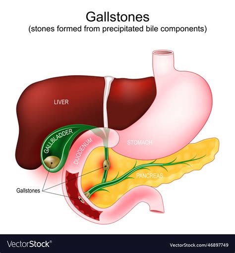 Gallstones parts of a digestive system Royalty Free Vector