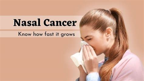 Nasal cavity cancer