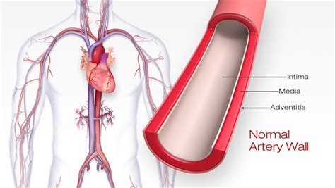 How to Reverse 20 Years of Arterial Plaque | PrevMed Health