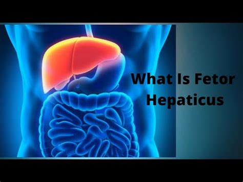 What Is Fetor Hepaticus - YouTube