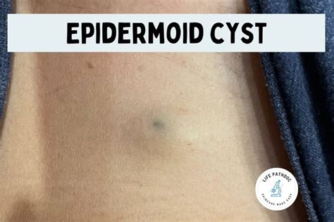 Epidermoid Cyst (EIC): Causes, Pictures & Removal