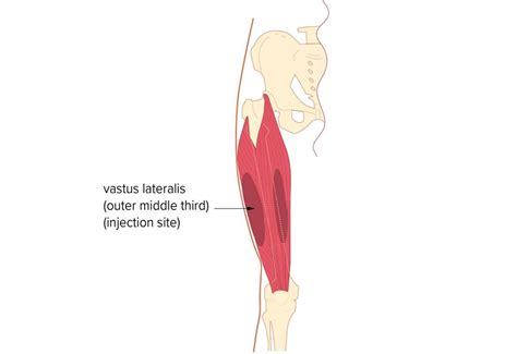 Intramuscular injection: Locations and administration in 2020 | Injections, Muscle relaxer ...