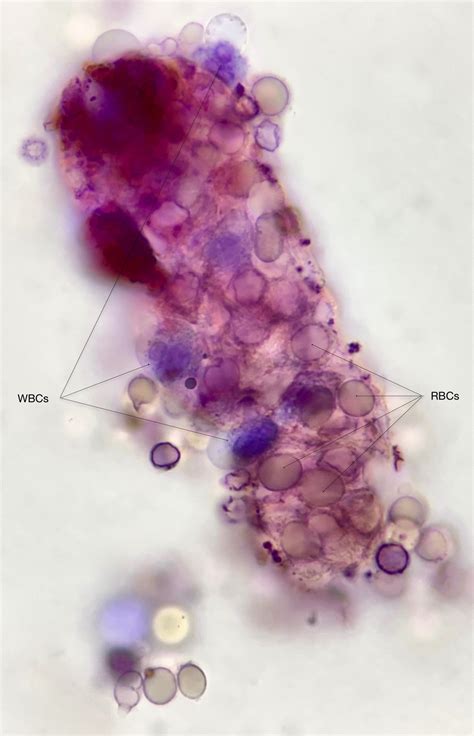 Urine Sediment of the Month: Mixed Cellular Casts - Renal Fellow Network