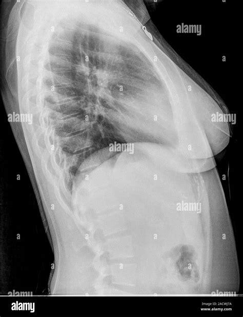 Chest x-ray of a 27 year old female suffering from Bronchitis. side ...