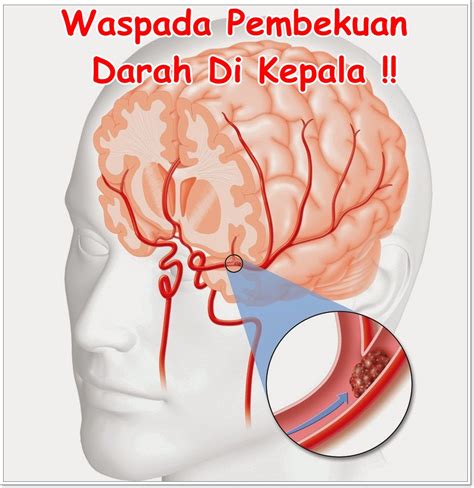 Jus Pengencer Pembekuan Darah Di Otak – Rana Herbal