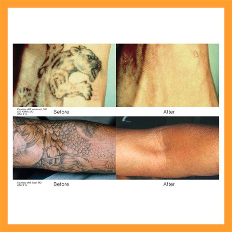 Revlite Laser | Melasma, Dark Underarms, Tattoo Removal,Skin Lightening