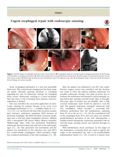 (PDF) Urgent esophageal repair with endoscopic suturing