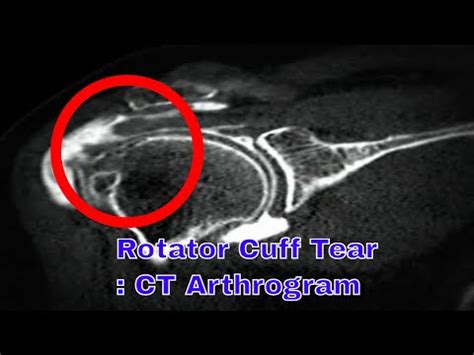 Rotator cuff tear of the shoulder : CT arthrogram finding - YouTube