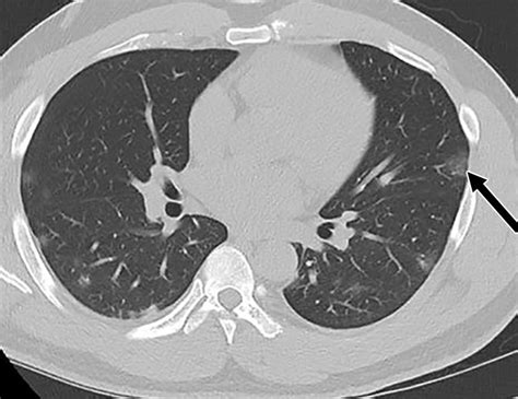 Case: 40 YO Man with McBurney Point Tenderness