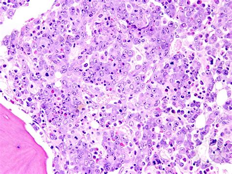 Anaplastic Large Cell Lymphoma Involving the Bone Marrow - 3.