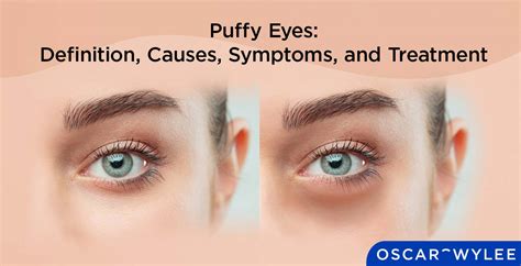 Puffy Eyes: Definition, Causes, Symptoms, and Treatment