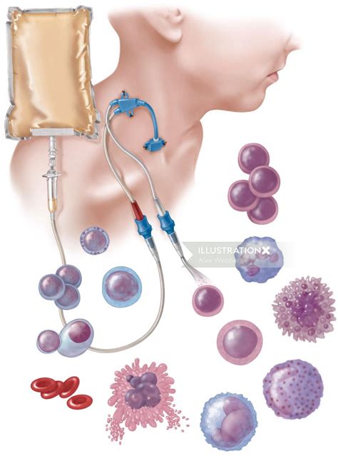 Hematopoietic Stem Cell Transplant | Illustration by Alex Webber