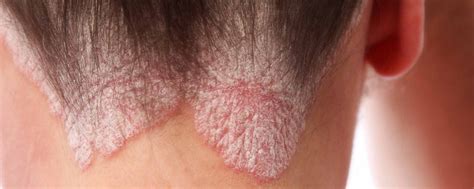 Get Scalp Psoriasis Under Control – ClinicalPosters