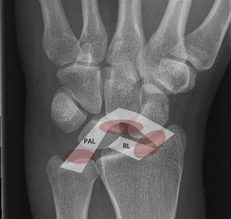 Midcarpal Instability - Hand Clinics