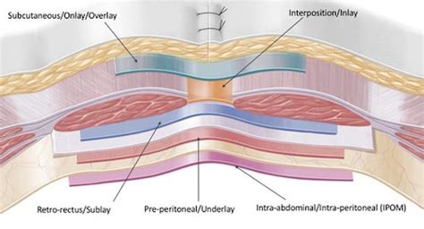 Ventral Hernia Repair - The Operative Review Of Surgery