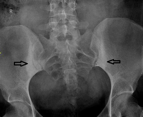 Cureus | Osteitis Condensans Ilii: An Uncommon Cause of Back Pain