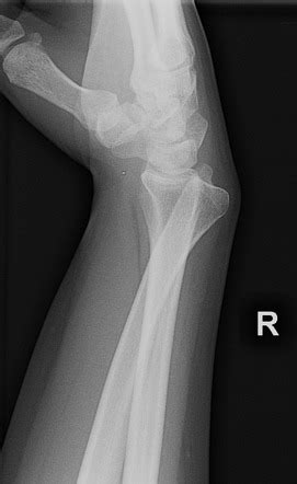 Distal radioulnar joint dislocation | Radiology Reference Article ...