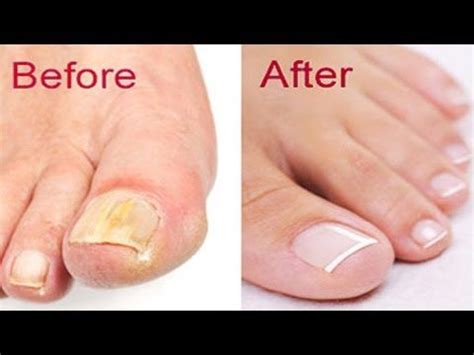 How To Use Apple Cider Vinegar For Toenail Fungus - Nail Care Palace