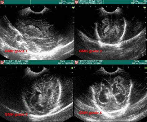 Ultrasound images with the classification of Papile et al. | Download ...