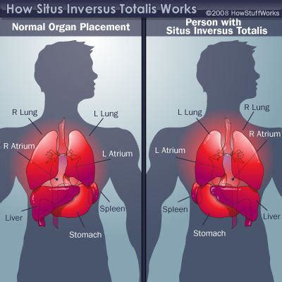 Dextrocardia