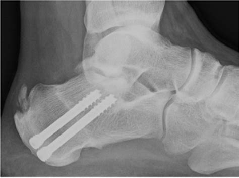 Postoperative X-ray of a dorsal wedge calcaneal osteotomy fixed with 2... | Download Scientific ...