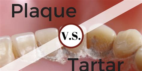 Plaque vs. Tartar: What's The Difference? - Britt Dental Center | Raleigh, NC Dentist