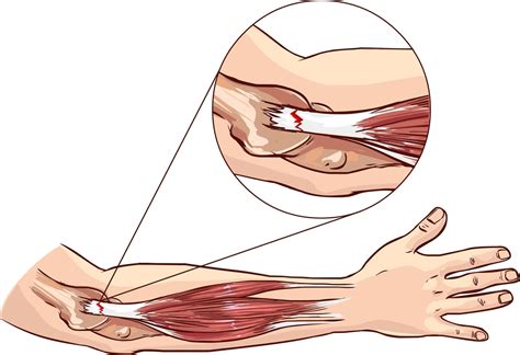 Codo de tenista - familydoctor.org