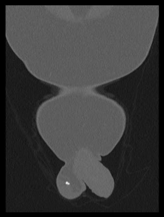 Scrotolith | Radiology Reference Article | Radiopaedia.org