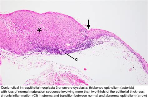 Pathology Outlines - Conjunctiva: conjunctival intraepithelial neoplasia