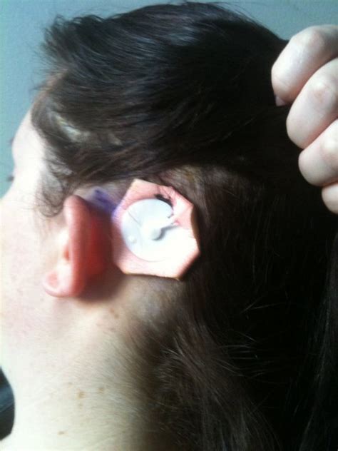 BAHA/BAHS surgery | Ear Community