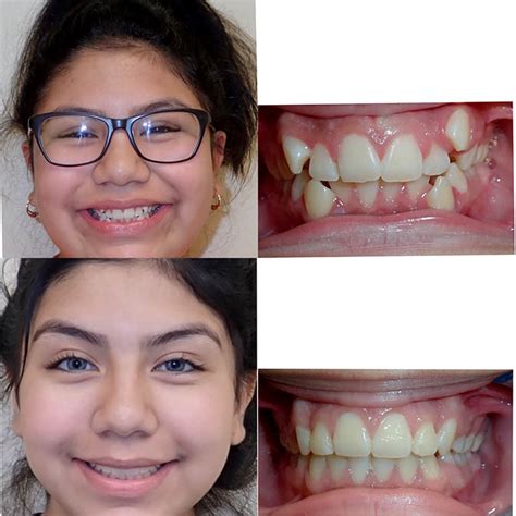 Braces Before And After Smile