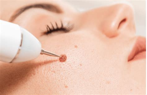 Mole Removal | Pinnacle Dermatology | Beaufort, SC