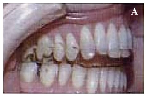 A) Occlusal splint in use (intra oral). B) The occlusal splint ...