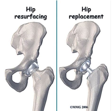 Medical Tourism Par Excellence!: Hip Resurfacing