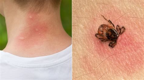 Is that a Mosquito or Tick Bite? How to Tell These Bug Bites Apart