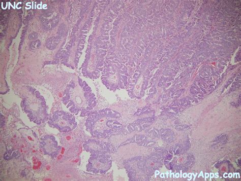 endometrial serous carcinoma pathology