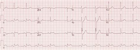 Inferior STEMI • LITFL • ECG Library Diagnosis