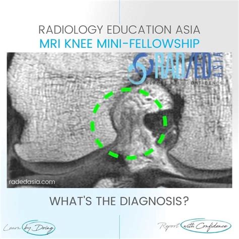 ACL TEAR MRI KNEE FINDINGS CORONAL IMAGES - Radedasia