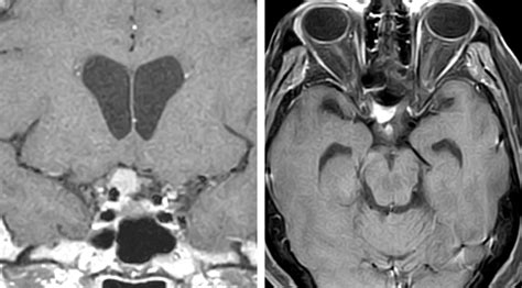 Medial Sphenoid Wing Meningioma | The Neurosurgical Atlas, by Aaron Cohen-Gadol, M.D.