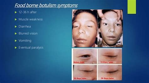 Clostridium botulinum disease