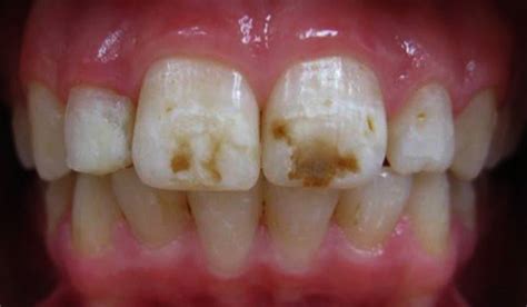 KöR Whitening Turns Skeptic into a Believer After a Challenging Fluorosis Case