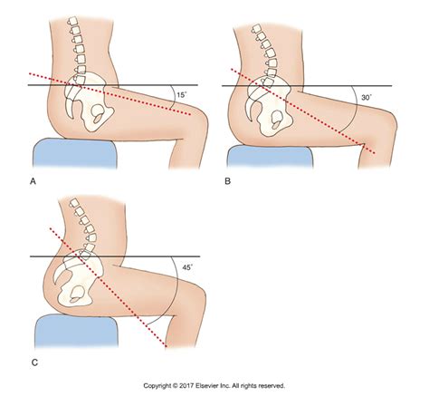 What is lower crossed syndrome and what are its causes?