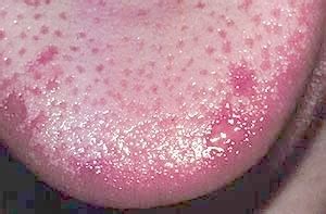 Herpes on tongue: Causes, Symptoms, Stages, Treatment, Pictures