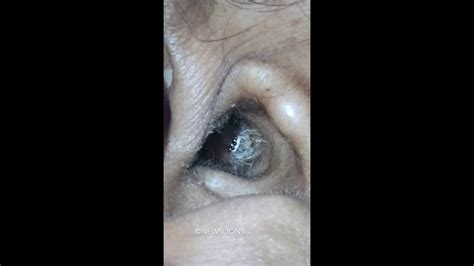 Doctors Find Spider Living In Woman's Ear [VIDEO]