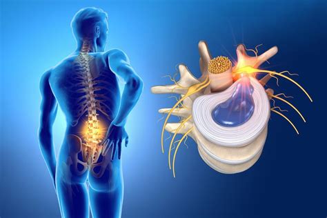 Herniated Disc Treatment