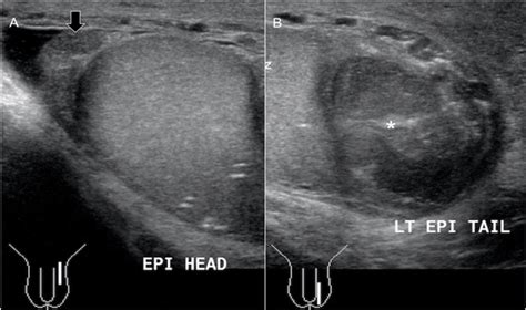 Ultrasound images (A & B) of the left scrotum. The sagittal view of the ...