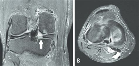 Medial Meniscus Body And Posterior Horn